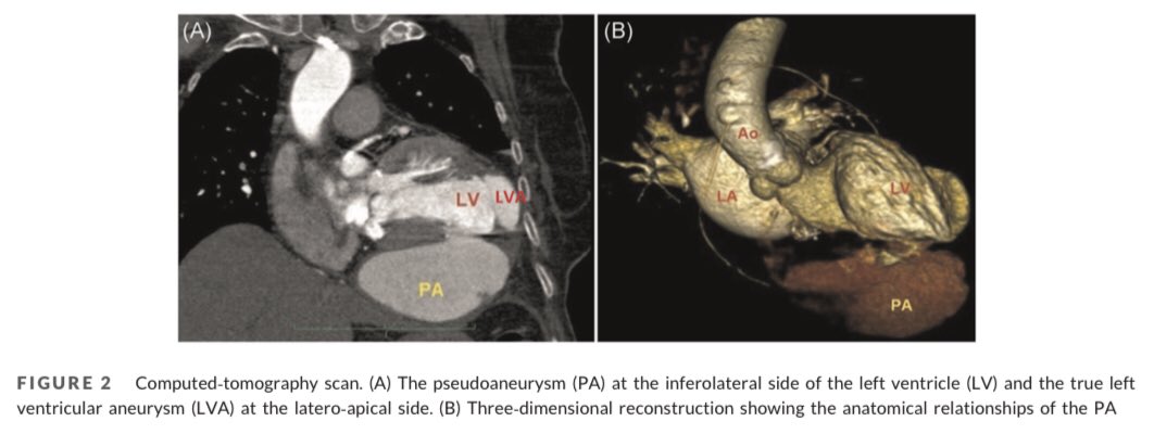 M_Pompeu_Sa_MD's tweet photo. 🔥Hot off the press🔥 Read our new case report just published in @JCardSurg https://t.co/ABXbjN7rN7. 84‐year‐old👵🏼 with progressive HF symptoms ➡️ now asymptomatic👍. Nice collaboration with @LCavalcantiMD, @Escorel_Neto_MD, @brunoholz, @drdiegogaia, @dramagno, @DrRicardoLima1. https://t.co/xcJrhVNEI0