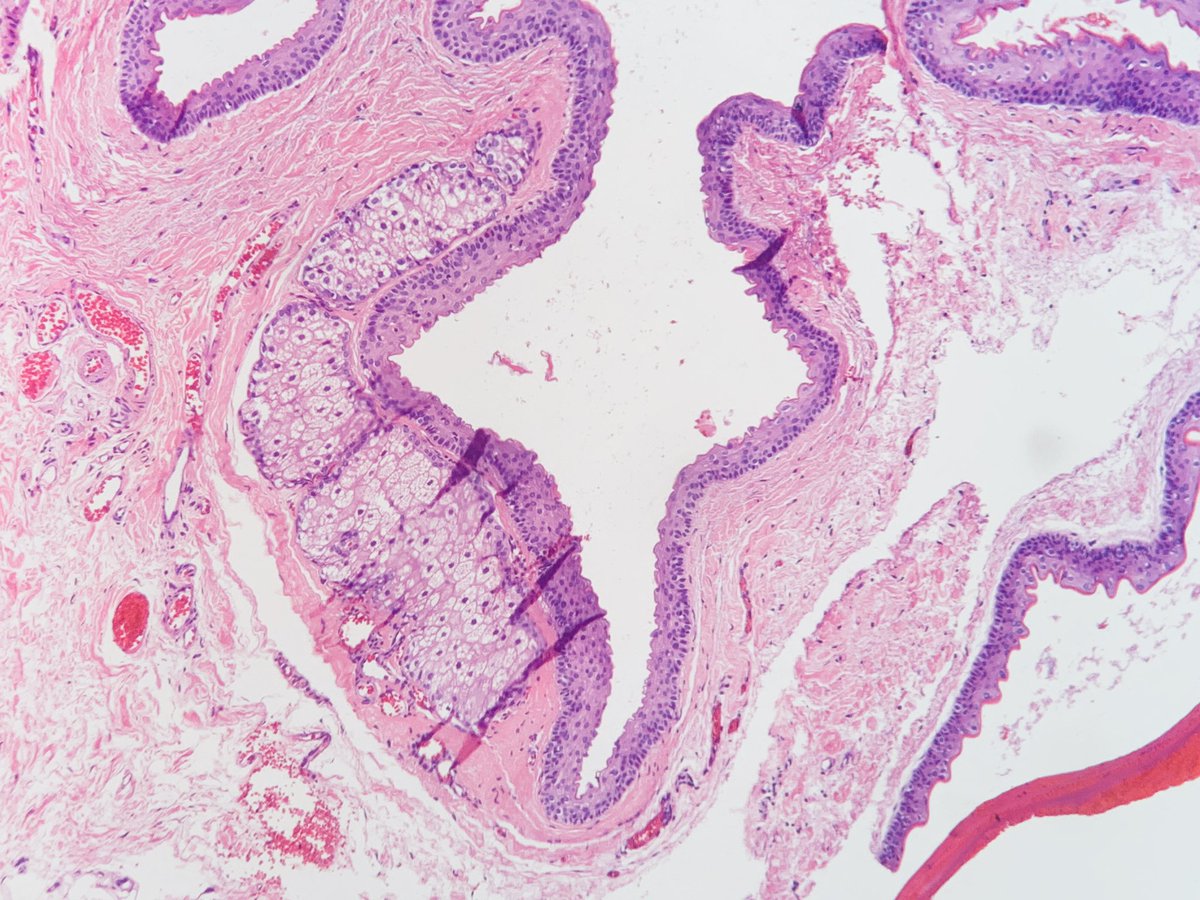 arakakiasato's tweet photo. Steatocystoma
Empty cyst with serpiginous wall and corrugated cuticle. Sebaceous glands adjacent to the cyst wall. https://t.co/slORsNfTXW