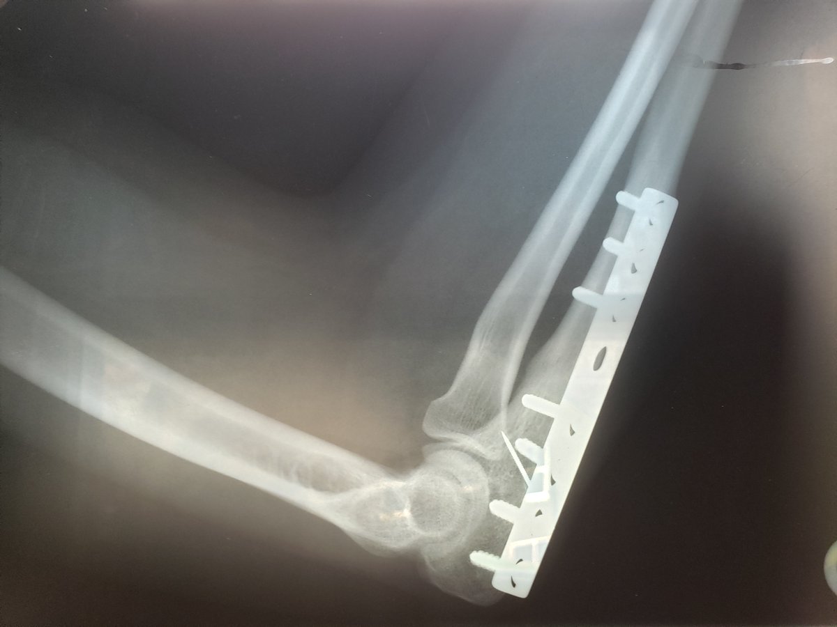 sciencePNNL's tweet photo. For #NationalPeriodicTableDay, @PNNLab communications team lead @sarah_logue has a righteous reason for choosing #titanium as her favorite element: the titanium plate in her right arm, as pictured. #PeriodicTable https://t.co/66Kk98HdzZ https://t.co/yxYPw8Ilor