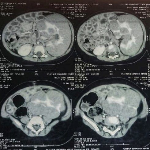 A 12 month female child with incidentally detected bilateral enlarged kidneys, right more than left 
#PathTwitter #pediatricpathology #srbct