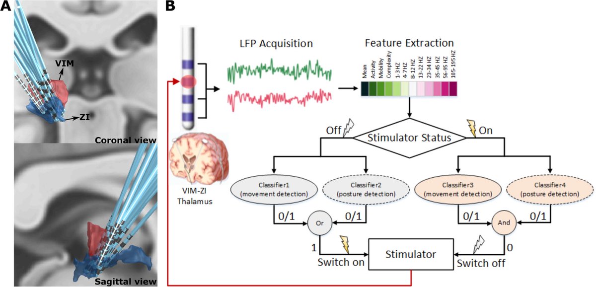 Erlick Pereira (@eacp) on Twitter photo The very gifted <a href="/ShenghongH/">Shenghong He</a> <a href="/MRCBNDU/">MRC BNDU, Oxford</a> <a href="/NDCNOxford/">Nuffield Department of Clinical Neurosciences</a> develops adaptive, closed-loop #DBS to control essential tremor more efficiently with us <a href="/baigneuro/">FB</a> <a href="/AbteenMostofi/">Abteen Mostofi</a> <a href="/STGNeurosurgery/">STGNeurosurgery</a> <a href="/STGNeuro/">St George's Neuro</a> <a href="/leaddbs/">Lead-DBS</a> (and a couple of <a href="/OUHospitals/">OUH</a> electrodes thrown in) …mentdisorders.onlinelibrary.wiley.com/doi/full/10.10… The very gifted <a href="/ShenghongH/">Shenghong He</a> <a href="/MRCBNDU/">MRC BNDU, Oxford</a> <a href="/NDCNOxford/">Nuffield Department of Clinical Neurosciences</a> develops adaptive, closed-loop #DBS to control essential tremor more efficiently with us <a href="/baigneuro/">FB</a> <a href="/AbteenMostofi/">Abteen Mostofi</a> <a href="/STGNeurosurgery/">STGNeurosurgery</a> <a href="/STGNeuro/">St George's Neuro</a> <a href="/leaddbs/">Lead-DBS</a> (and a couple of <a href="/OUHospitals/">OUH</a> electrodes thrown in) …mentdisorders.onlinelibrary.wiley.com/doi/full/10.10…