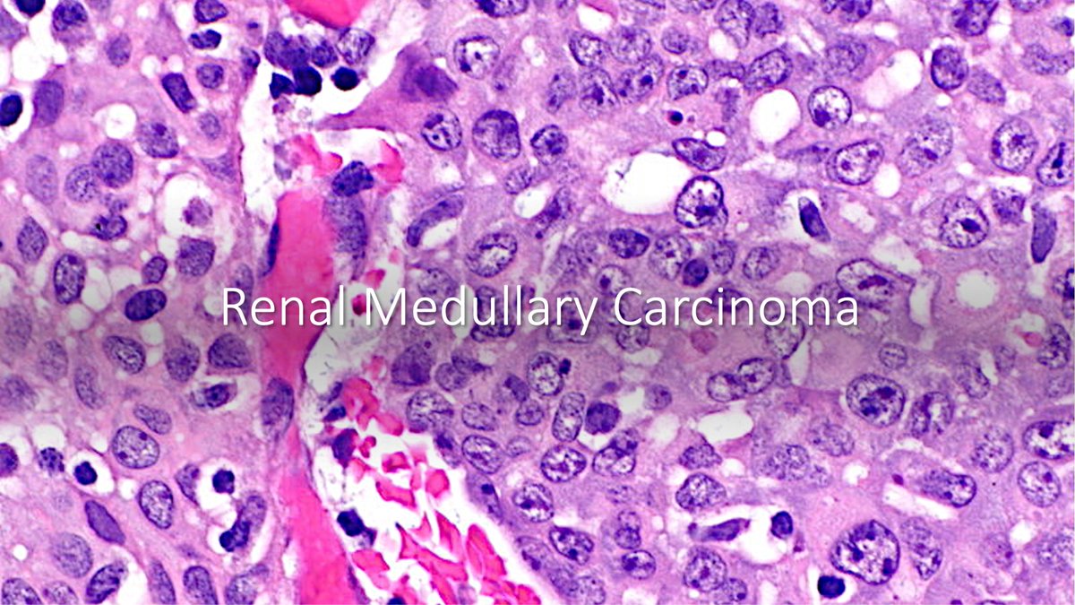 AAlhatem_MD's tweet photo. INI1 (SMARCB1) LOSS TUMORS (1/2):
1- Epitheloid Sarcoma 
2- Malignant Myoepithelioma (50%)
3- Epithelioid MPNST (50%)
4- Renal Medullary Carcinoma
5- Atypical teratoid/rhabdoid tumor 
6- Malignant Extra-Renal Rhabdoid Tumor
Pics source: @wikipedia #pathresidents #boardexams https://t.co/xefLhqOTP8