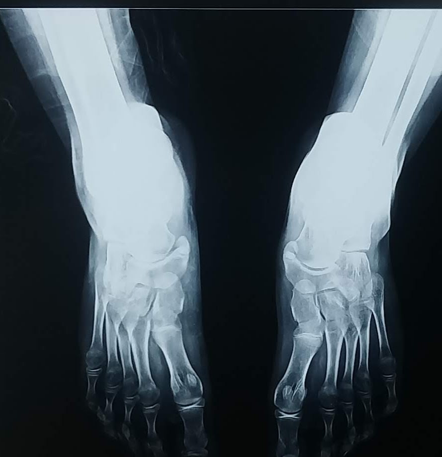 Orthoquote's tweet photo. The covid pandemic and the subsequent lockdown has precipitated a pandemic of Flatfeet in children. We've seen a lot many asymptomatic flat feet children turning symptomatic. 

"Find me one patient with accessory navicular who doesn't have Flatfeet"
#orthotwitter #Orthotweets https://t.co/cMwrCYkmHy