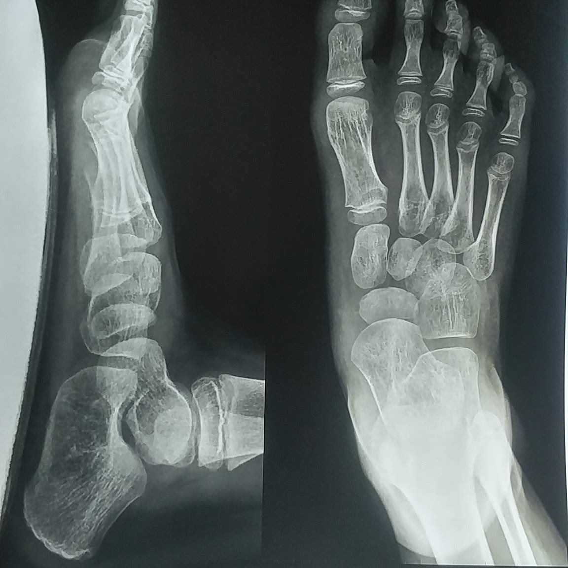 Orthoquote's tweet photo. The covid pandemic and the subsequent lockdown has precipitated a pandemic of Flatfeet in children. We've seen a lot many asymptomatic flat feet children turning symptomatic. 

"Find me one patient with accessory navicular who doesn't have Flatfeet"
#orthotwitter #Orthotweets https://t.co/cMwrCYkmHy