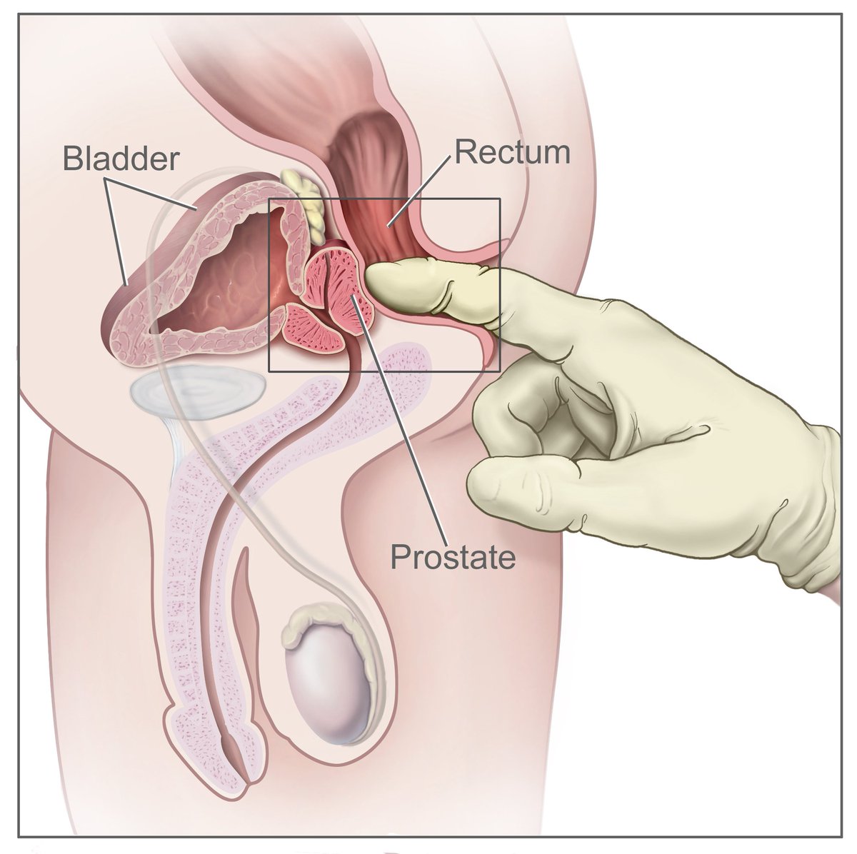 Another one, which is specific to the males, is the early diagnosis of a prostate problem which include a benign (harmless) mass or a cancer. Both potentially presenting as a problem with peeing as explained in this picture 