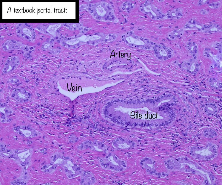 Discussion: I felt this was a nice case of bile duct adenoma. Some annotated images are posted below.