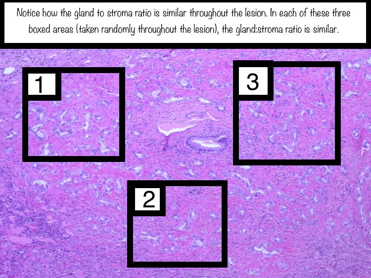 Thank you to  @RhondaYantiss and  @merepitt for letting me borrow the cancer images from their excellent & comprehensive review article on this topic:  https://pubmed.ncbi.nlm.nih.gov/29751885/ 