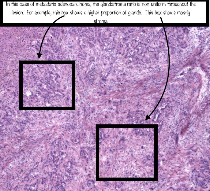 Thank you to  @RhondaYantiss and  @merepitt for letting me borrow the cancer images from their excellent & comprehensive review article on this topic:  https://pubmed.ncbi.nlm.nih.gov/29751885/&nbsp;
