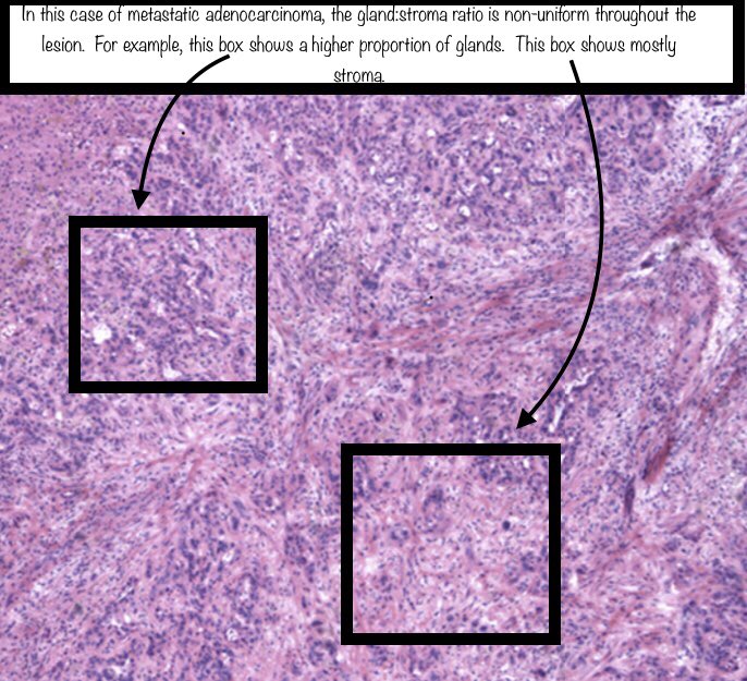 Thank you to  @RhondaYantiss and  @merepitt for letting me borrow the cancer images from their excellent & comprehensive review article on this topic:  https://pubmed.ncbi.nlm.nih.gov/29751885/ 