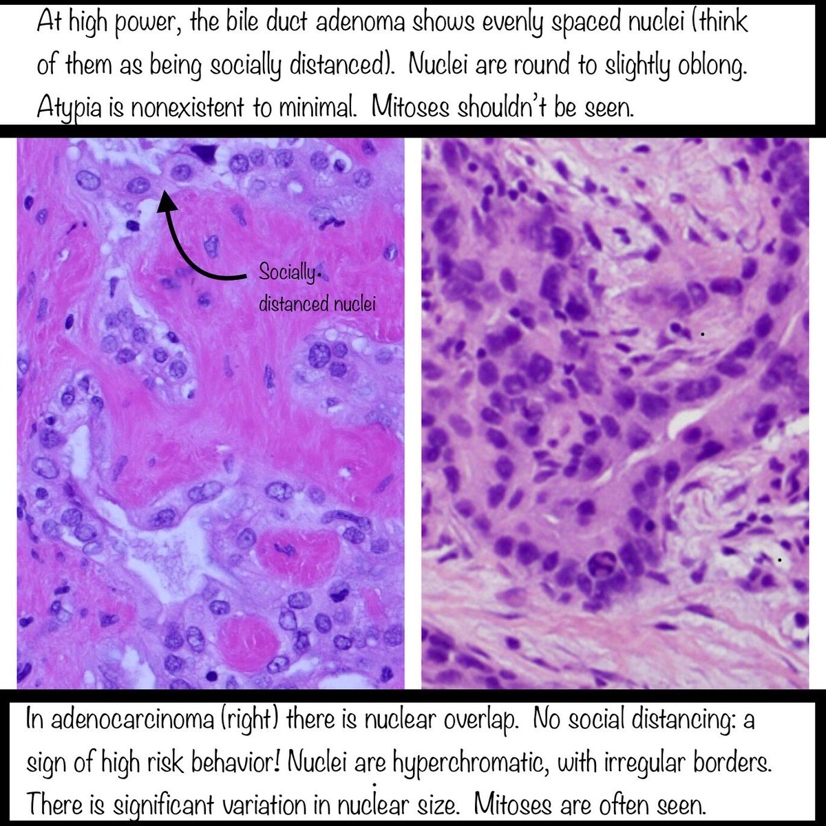 Thank you to  @RhondaYantiss and  @merepitt for letting me borrow the cancer images from their excellent & comprehensive review article on this topic:  https://pubmed.ncbi.nlm.nih.gov/29751885/ 