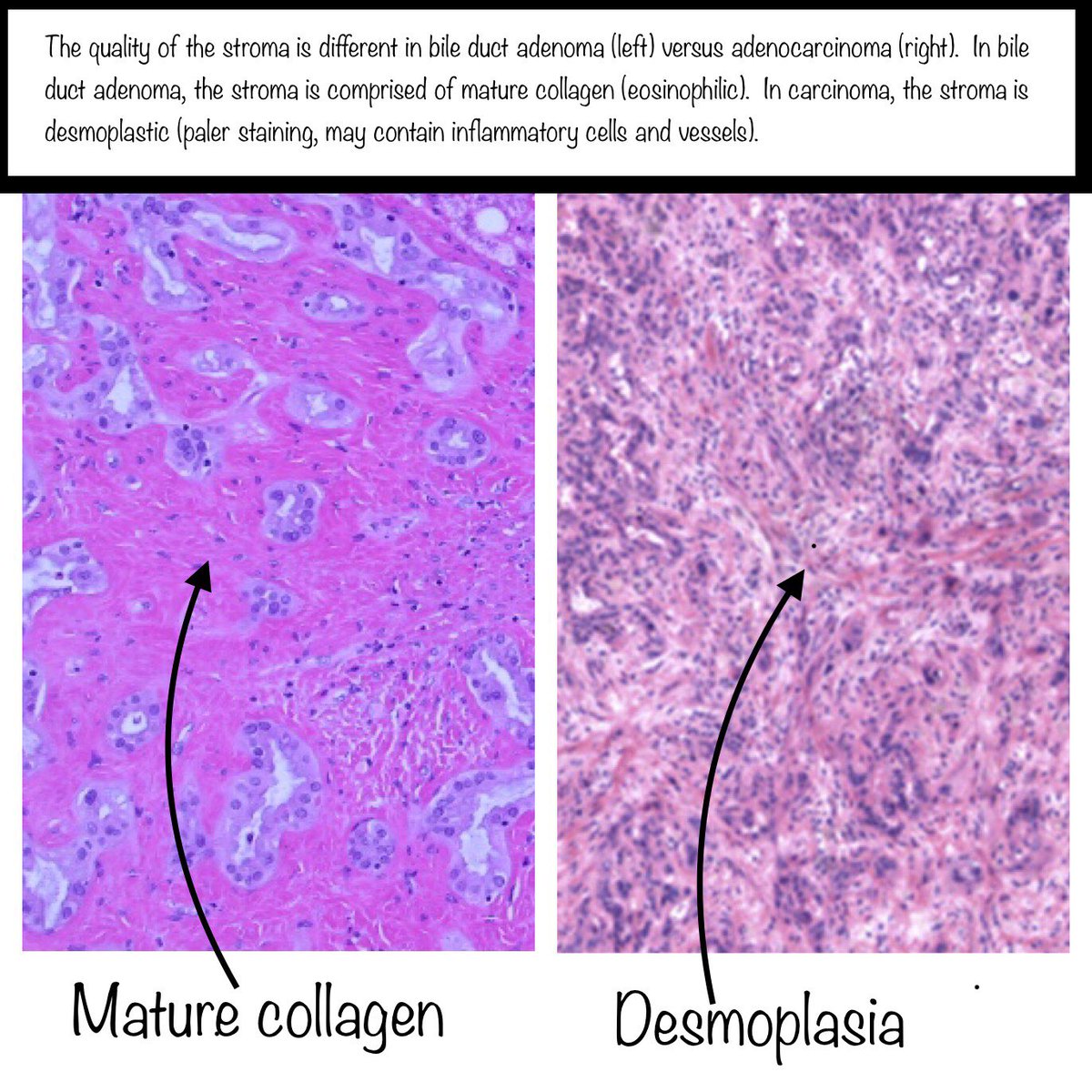 Thank you to  @RhondaYantiss and  @merepitt for letting me borrow the cancer images from their excellent & comprehensive review article on this topic:  https://pubmed.ncbi.nlm.nih.gov/29751885/&nbsp;