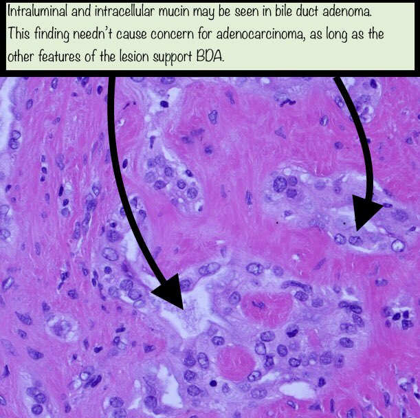 Thank you to  @RhondaYantiss and  @merepitt for letting me borrow the cancer images from their excellent & comprehensive review article on this topic:  https://pubmed.ncbi.nlm.nih.gov/29751885/ 