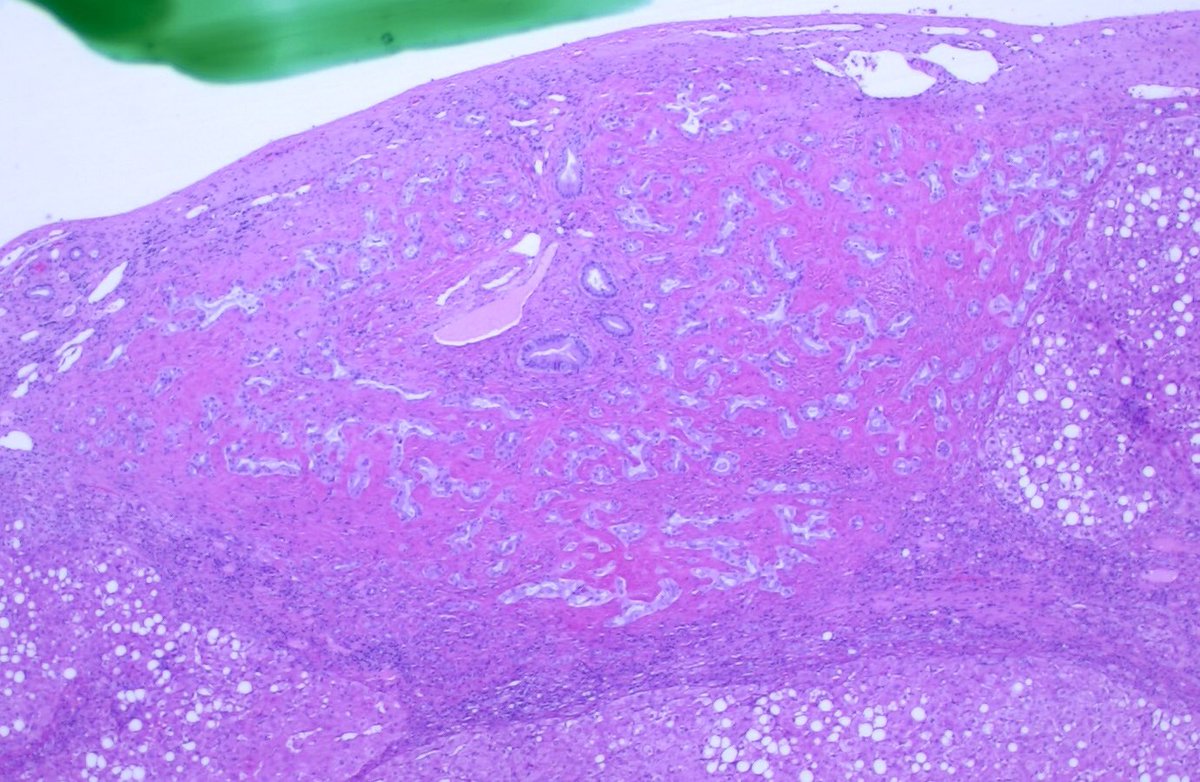  #GIpath  #Liverpath  #pathresidents 50 year old man; liver wedge resection. History of indeterminate pancreas lesion by imaging (chronic pancreatitis vs mass).A few images, a poll, and a  #tweetorial