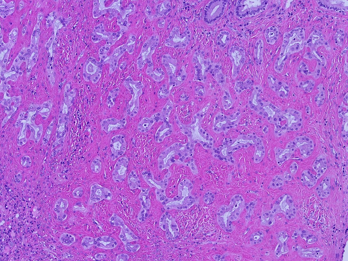  #GIpath  #Liverpath  #pathresidents 50 year old man; liver wedge resection. History of indeterminate pancreas lesion by imaging (chronic pancreatitis vs mass).A few images, a poll, and a  #tweetorial