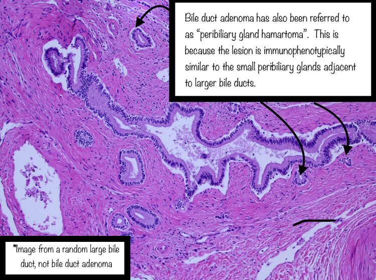 Discussion: I felt this was a nice case of bile duct adenoma. Some annotated images are posted below.