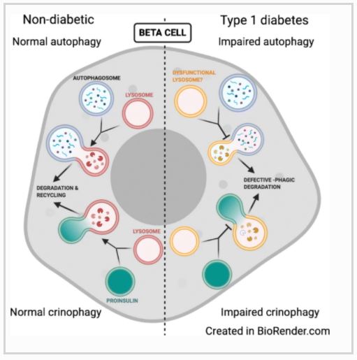 Diabetologia (@diabetologiajnl) on Twitter photo Islet autophagy and crinophagy are reduced in human type 1 diabetes. <a href="/LinnemannLab/">Amelia Linnemann, Ph.D.</a> <a href="/IUSweetTweets/">Center for Diabetes and Metabolic Diseases</a> <a href="/IUMedSchool/">IU School of Medicine</a> <a href="/DiabetesnPOD/">nPOD Diabetes</a> #T1D #Islets bit.ly/3aFTx7U 🔓 Islet autophagy and crinophagy are reduced in human type 1 diabetes. <a href="/LinnemannLab/">Amelia Linnemann, Ph.D.</a> <a href="/IUSweetTweets/">Center for Diabetes and Metabolic Diseases</a> <a href="/IUMedSchool/">IU School of Medicine</a> <a href="/DiabetesnPOD/">nPOD Diabetes</a> #T1D #Islets bit.ly/3aFTx7U 🔓
