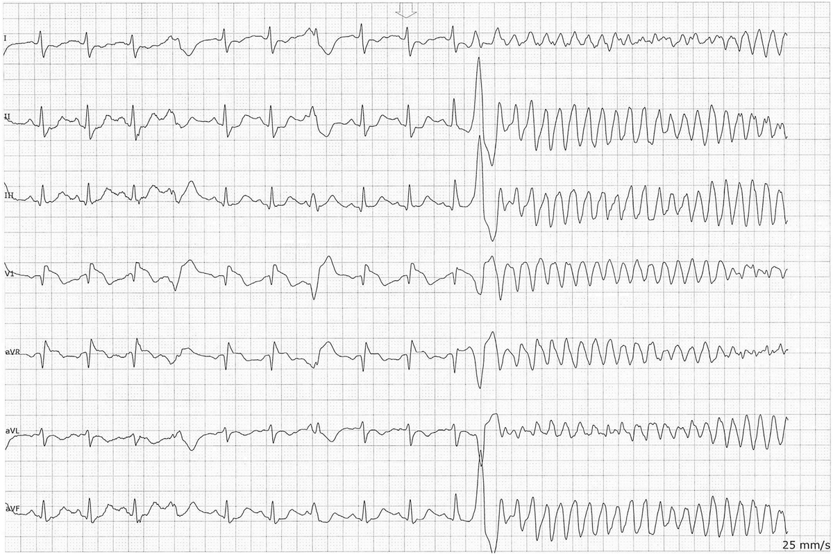 Electrical storm in patient with #Brugadasyndrome and #COVIDー19  infection, reference from Maglione et al. @HRSonline #Cardio #EPeeps @ecgrhythms