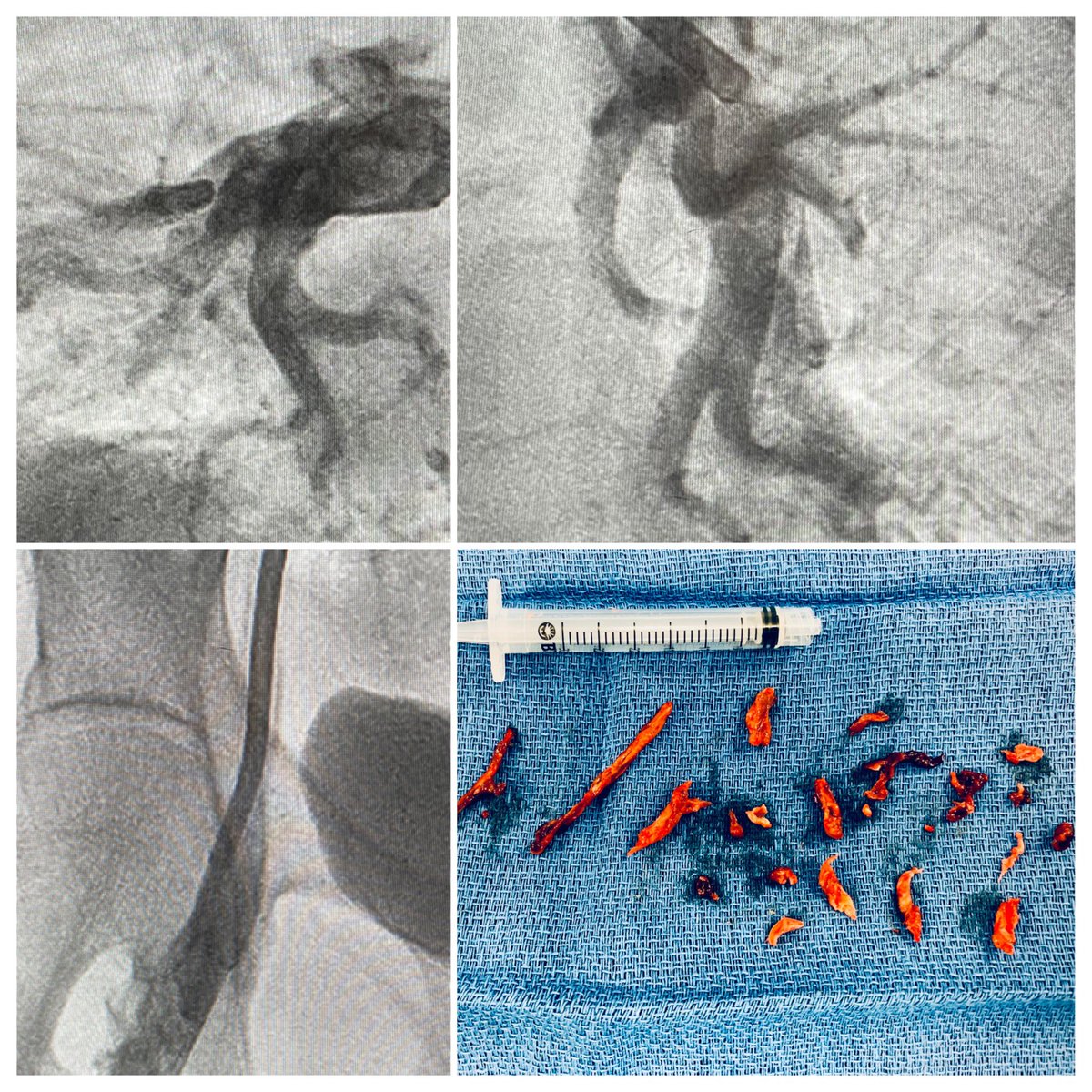 Malcolm T. Foster III, MD (@malcolmfoster3) on Twitter photo Bilateral PE with DVT of the RLE. Single session thrombectomy with Penumbra L-12F. No lytics. Modest blood 🩸 loss. Immediate OAC. Telemetry overnight and discharged home. #cardiotwitter  #penumbra Bilateral PE with DVT of the RLE. Single session thrombectomy with Penumbra L-12F. No lytics. Modest blood 🩸 loss. Immediate OAC. Telemetry overnight and discharged home. #cardiotwitter  #penumbra
