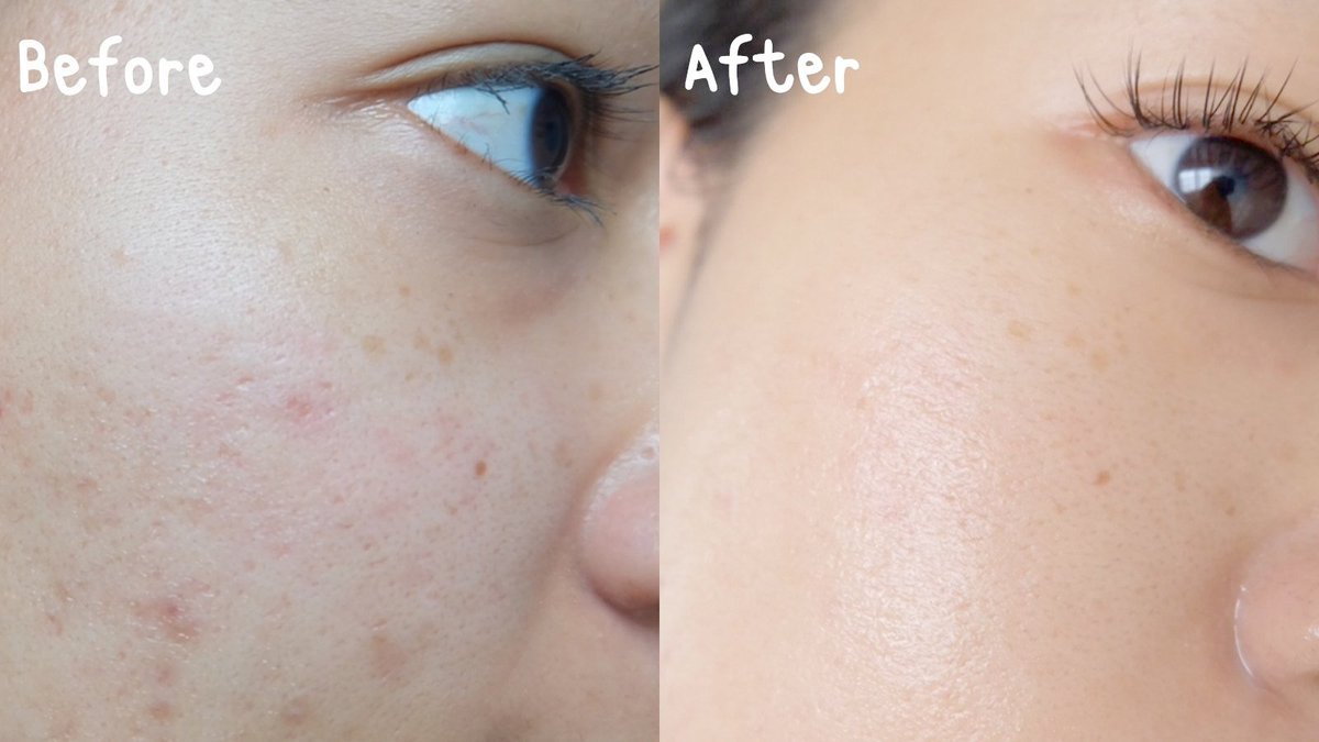 ในที่สุดก็เจอ !!! วิตซีที่ชอบมาก <a href="/SkinsistaTH/">Skinsista Official</a> เป็นวิตซีเข้มข้น เนื้อบางเบา ที่มีส่วนผสมไฮยา ช่วยปรับสภาพผิว บำรุงให้หน้าใส ผลัดเซลล์ผิวอย่างอ่อนโยน​ ใช้แล้วไม่แสบผิวเลยคือดีอะ หลังใช้ผิวใสขึ้นมว้าก ถูกและดีจริงๆ พิกัดวัตสันเลย ราคา 395 บาทเองจ้า #ใช้ดีบอกต่อ #รีวิววัตสัน