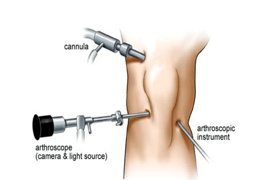 ejmaces123's tweet photo. #Surgeons can look at the interior of a joint with the use of an #arthroscope. This technique is most often used to inspect and possibly repair the inside of the #knee, shoulder, or #hip joint. https://t.co/ZpexDVgUtd