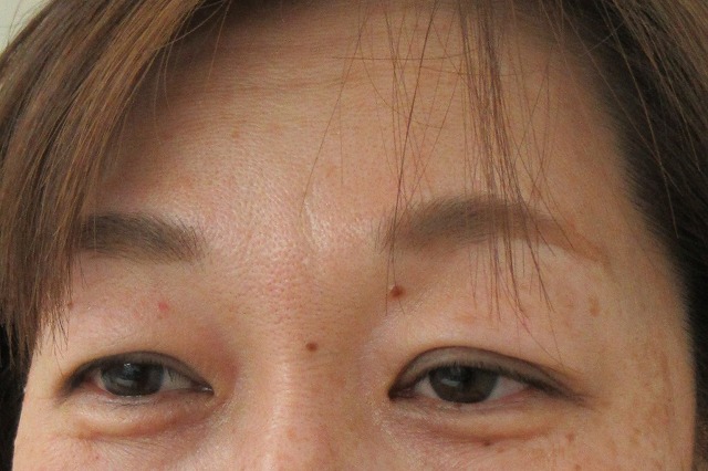 六本木境クリニック 二重埋没も切開も眼瞼下垂も目頭切開も 目尻切開もたれ目形成 グラマラスラインも 美容整形って不自然だと他人からでもバレる 自然だと激変しても家族からもバレない 画像は右は眉下切開後