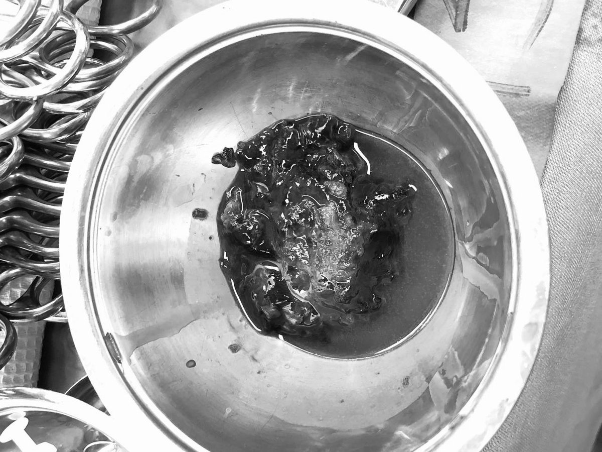 2021 оны манай 15 дахь зүрхний нээлттэй мэс засал. Зүрхний хиймэл хоёр хавтаст хавхлага суулгаж 3 хаватаст хавхлагыг нь засав. Зүрхэн дотор дүүрэн бүлэн байсныг нь авч чөлөөтэй болгов. Эсвэл зүрх бүлэндээ бөглөрч зогсох эсвэл бүлэн тасарч харвалт болох өндөр эрсдэлтэй байж. Амжив