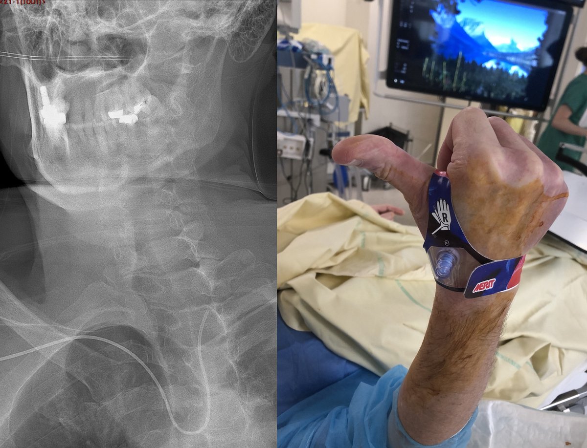 Jildaz Caroff 👨🏻⚕️ (@jildazz) on Twitter photo Modern Era of Neurointerventional Surgery #INR is a blast💥
.
.
Perfect 3 months follow up of one of the most distal mini flow-diverter stent ever @balt_usa
.
.
Distal #RadialFirst angio #RadialForNeuro
.
.
<a href="/APHP/">Assistance Publique – Hôpitaux de Paris (AP-HP)</a>
#Stroke #Aneurysm #Neurosurgery #Radiology #Endovascular #Stent Modern Era of Neurointerventional Surgery #INR is a blast💥
.
.
Perfect 3 months follow up of one of the most distal mini flow-diverter stent ever @balt_usa
.
.
Distal #RadialFirst angio #RadialForNeuro
.
.
<a href="/APHP/">Assistance Publique – Hôpitaux de Paris (AP-HP)</a>
#Stroke #Aneurysm #Neurosurgery #Radiology #Endovascular #Stent