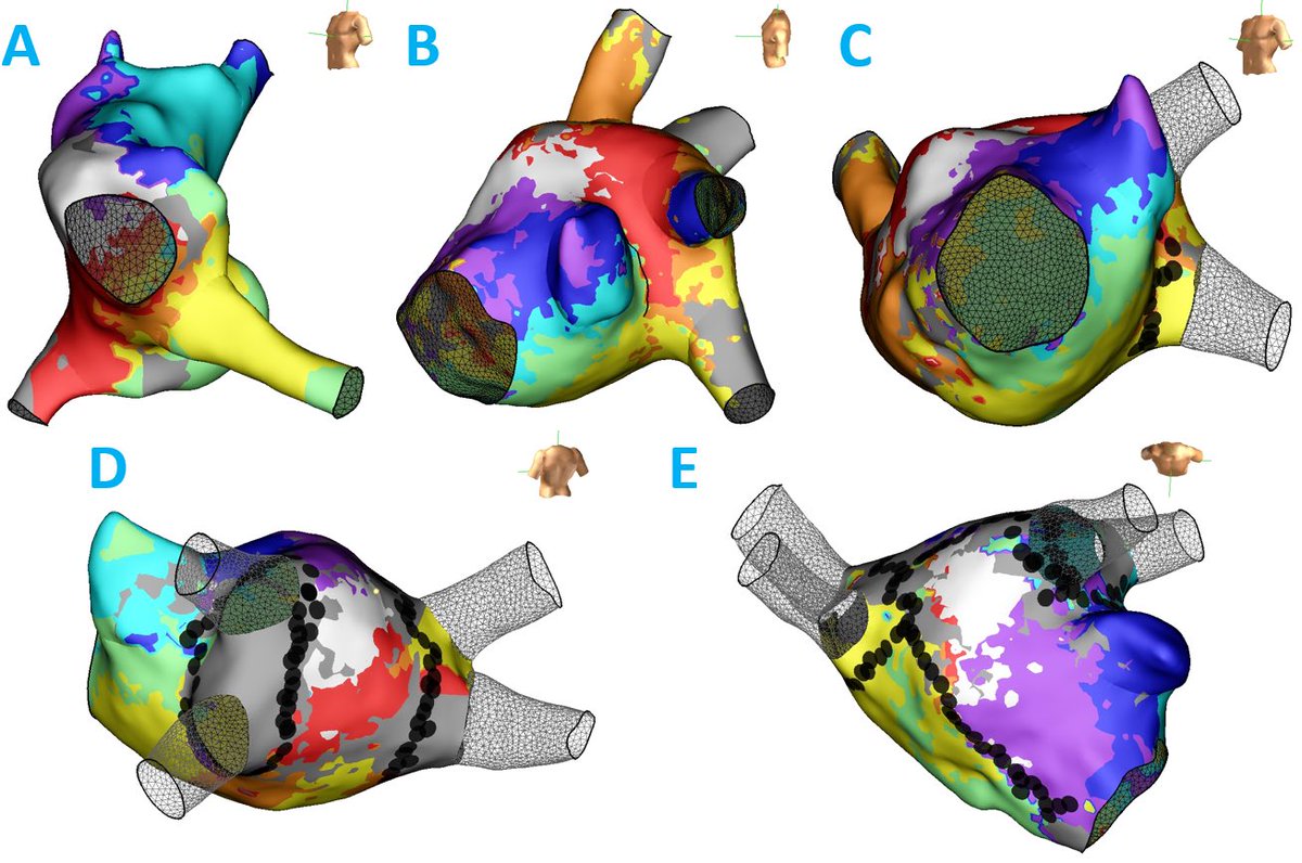 5 years ago this case would probably have been abandoned. Not with the #HDGrid. A. Typical AFL -> B. Functional reentry in LAA -> C. CCW perimitral AFL -> D. Roof AFL -> E. CCW perimitral AFL with gap in anterior line -> termination. #EPeeps #ProudtobeAbbott <a href="/andresenriqueza/">Andres Enriquez</a>