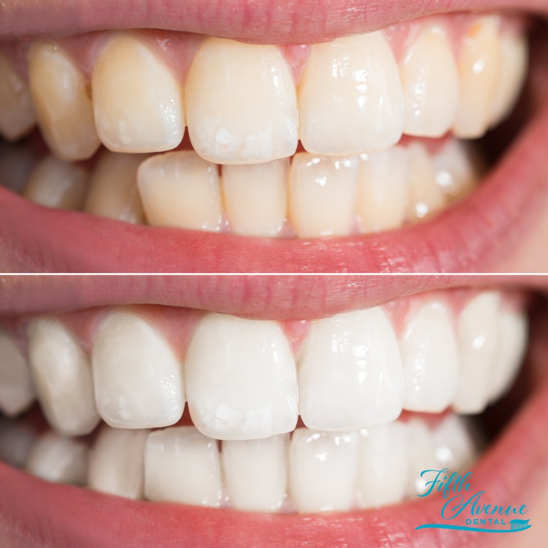 Tooth whitening or bleaching is a simple, non-invasive dental treatment used to change the colour of natural tooth enamel and is an ideal way to enhance the beauty of your smile.

CALL US TODAY to get started! 👄

☎️ (519) 941-5801
fifthavenuedental.com
