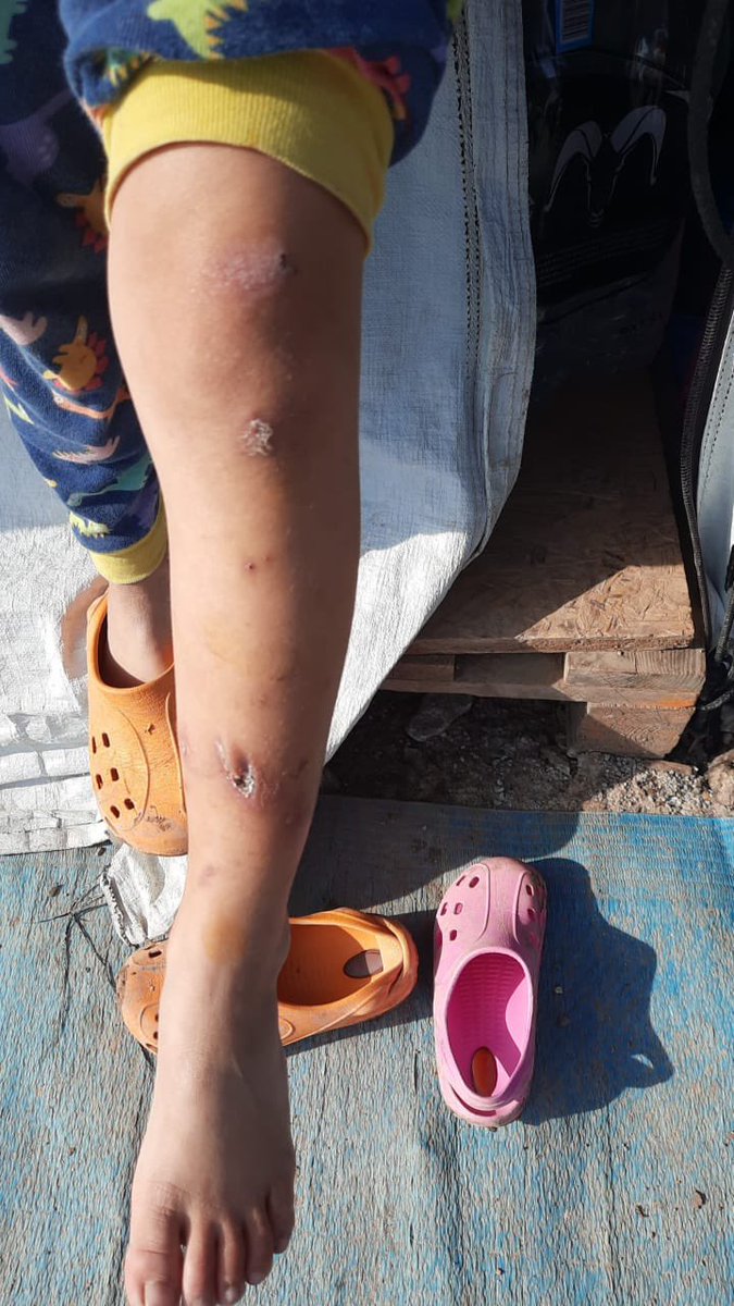 Franziska Grillmeier Cn Wounds Meanwhile In Karatepe Campresidents Report A Severe Outbreak Of Scabies Again Esp Among Children Due To A Lack Of Hygienic Conditions And The Difficulty Of