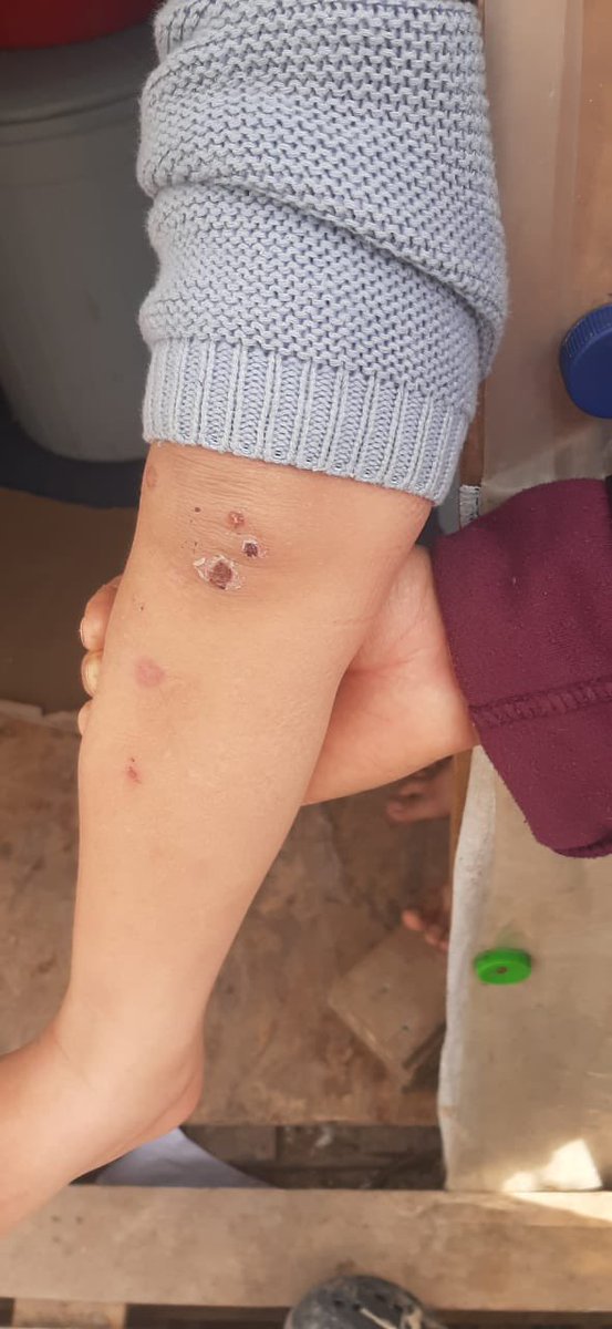 Franziska Grillmeier Cn Wounds Meanwhile In Karatepe Campresidents Report A Severe Outbreak Of Scabies Again Esp Among Children Due To A Lack Of Hygienic Conditions And The Difficulty Of