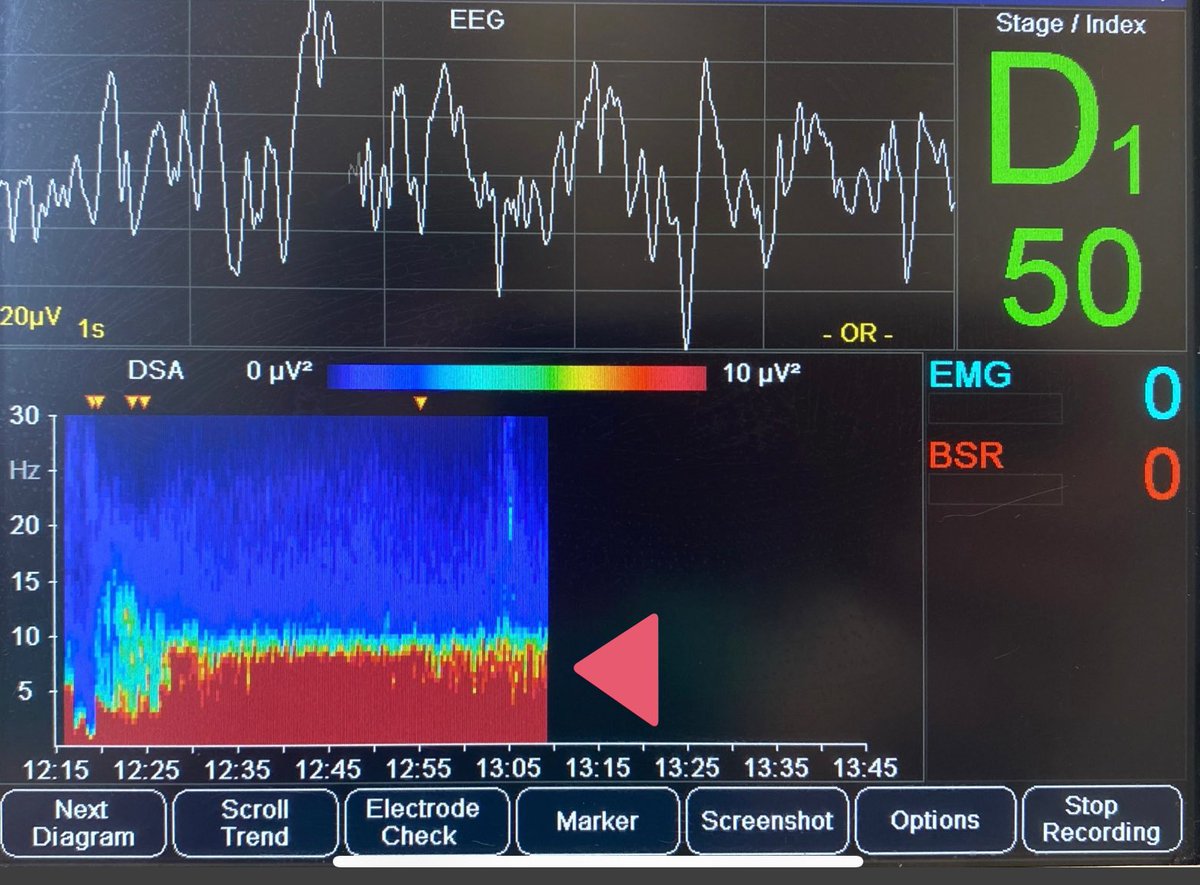 Relative Band Activity and DSA demonstrating theta (cyan), and the “fill in” effect noted on the DSA with ETaa around 1 MAC. Science in action. Note “the gap” occurring at induction d/t slow wash in of sevo despite immediate transition (so give a little Propofol ping!)