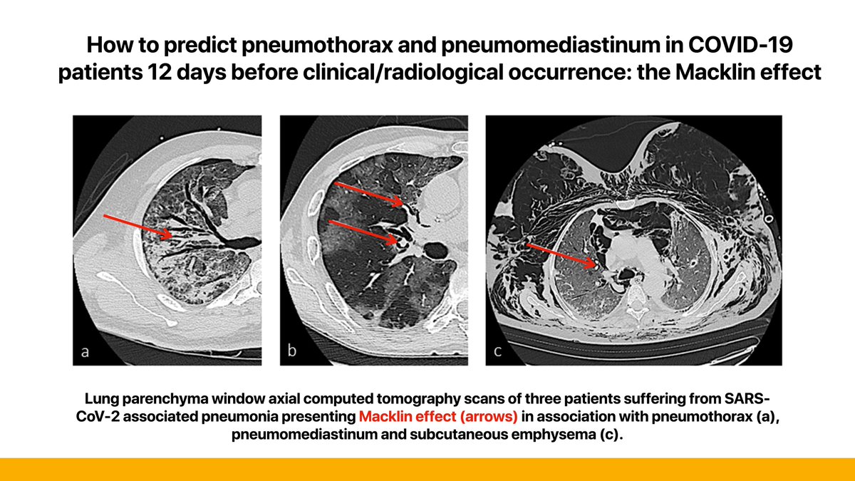 How to predict pneumothorax and pneumomediastinum in #COVID19 patients 12 days before clinical/radiological occurrence: the Macklin effect Read the THREAD and the article in @JCVAonline 🔗 jcvaonline.com/article/S1053-… #FOAMed #FOAMcc