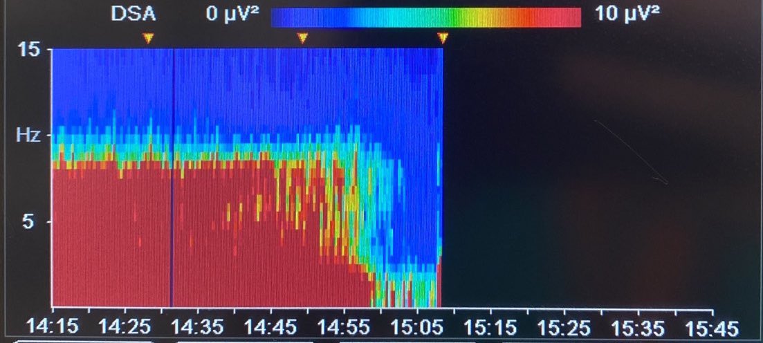 Emergence trajectory a little different; loose theta first then alpha roll and delta decay.