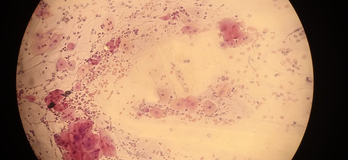 MinadjPath's tweet photo. Pap test 43F
Your diagnos? https://t.co/Pi8ZQN4H4d