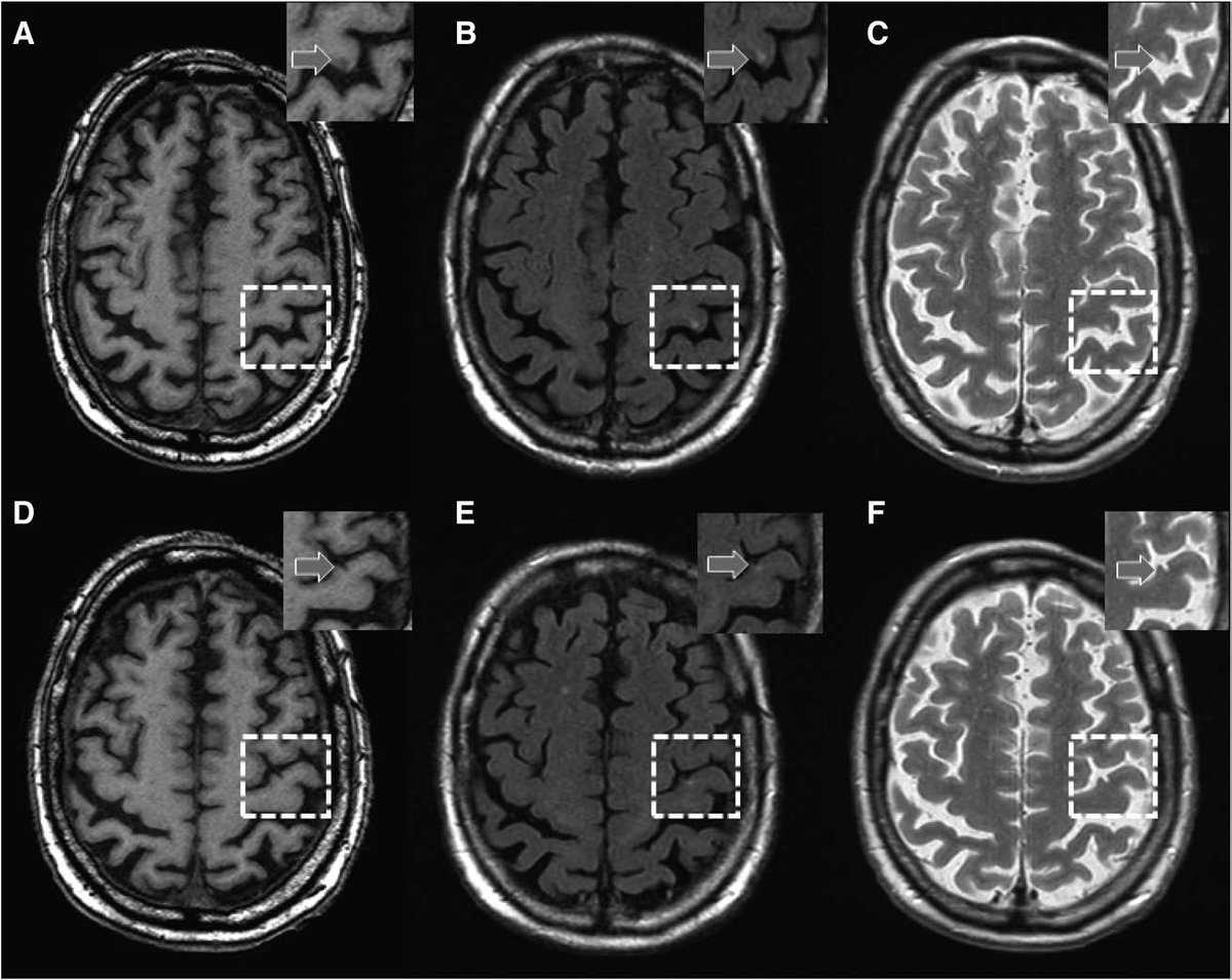 Stroke AHA/ASA (@strokeaha_asa) on Twitter photo Clinical Relevance of Cortical Cerebral Microinfarcts on 1.5T Magnetic Resonance Imaging in the Late-Adult Population by <a href="/HilalSaima/">Saima Hilal</a> et al #MRI #stroke ow.ly/ID2Y50DuvPA Clinical Relevance of Cortical Cerebral Microinfarcts on 1.5T Magnetic Resonance Imaging in the Late-Adult Population by <a href="/HilalSaima/">Saima Hilal</a> et al #MRI #stroke ow.ly/ID2Y50DuvPA