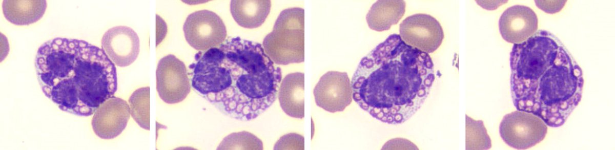 BWHPath's tweet photo. #BWHPathCotW

Peripheral blood smear from an older woman with acute myeloid leukemia on treatment presenting with fever. What is the diagnosis? #pathology #hemepath

1/ https://t.co/ENc1OKlyo4