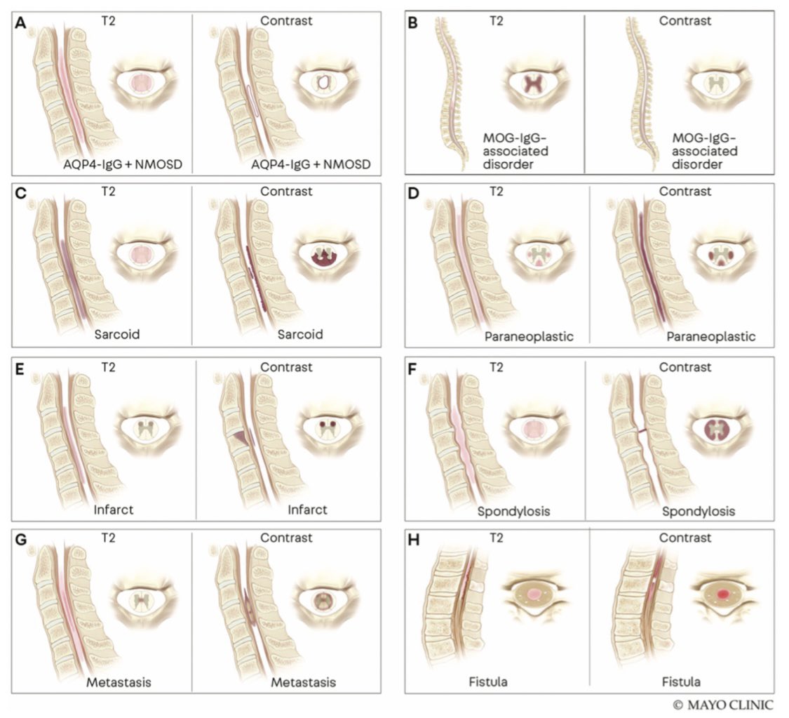 For this review we made illustrative figures that I hope you will find very helpful for your clinical practice! Recognizing radiographic patterns is crucial to accurately identify the etiology as  @rafidmustafa recently showed here :  https://bit.ly/39o5wrg&nbsp; 7/7