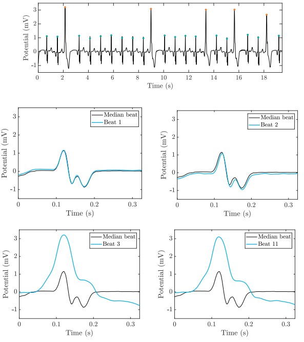 Check out our new paper describing a PVC detection algorithm that incorporates a novel 'cross-bin distance' metric to improve binary classification of single lead ECG recordings. bit.ly/2LutS9s #EPeeps @JonPicciniSr @DukeCardFellows @DukeHeartCenter