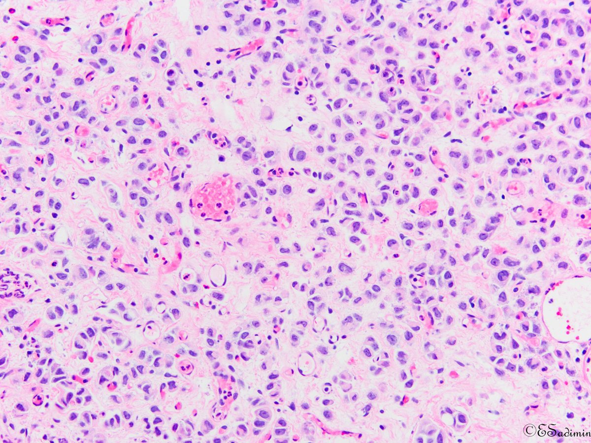 Evita Sadimin (@esadimin) on Twitter photo Plasmacytoid urothelial carcinoma (GATA3, CK7 and p40 positive) #pathology #pathologists #GUpath #pathboards <a href="/PathologyRWJMS/">Rutgers RWJMS Pathology</a> Plasmacytoid urothelial carcinoma (GATA3, CK7 and p40 positive) #pathology #pathologists #GUpath #pathboards <a href="/PathologyRWJMS/">Rutgers RWJMS Pathology</a>