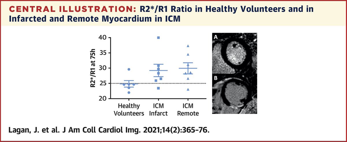 JACCJournals's tweet photo. A novel #CMR protocol in #cardiomyopathy patients using #USPIO identifies persistent myocardial inflammation in chronic ischemic cardiomyopathy, providing direct evidence of a substrate for the inflammation-heart failure hypothesis. Learn more: https://t.co/UgzHCCYugT #JACCIMG https://t.co/bcKqaOzUt5