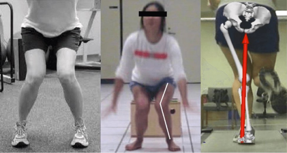 This is *not* inherently bad, but if taken too far, you can see a knee valgus moment occur as a lack of pronation at the foot can cause an inwardly collapse of the knee as it tries to find internal rotation.This applies to any movement requiring pronation & high loads/velocity.