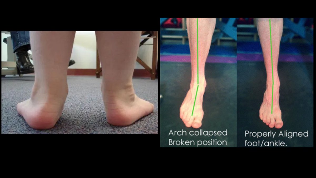 The biggest misconception I see is that people think pronation is the collapsing inward of the foot as a whole.That is not the case, and a collapsed foot is indicative of a foot that is likely compensating into pronation, rather than achieving true pronation.
