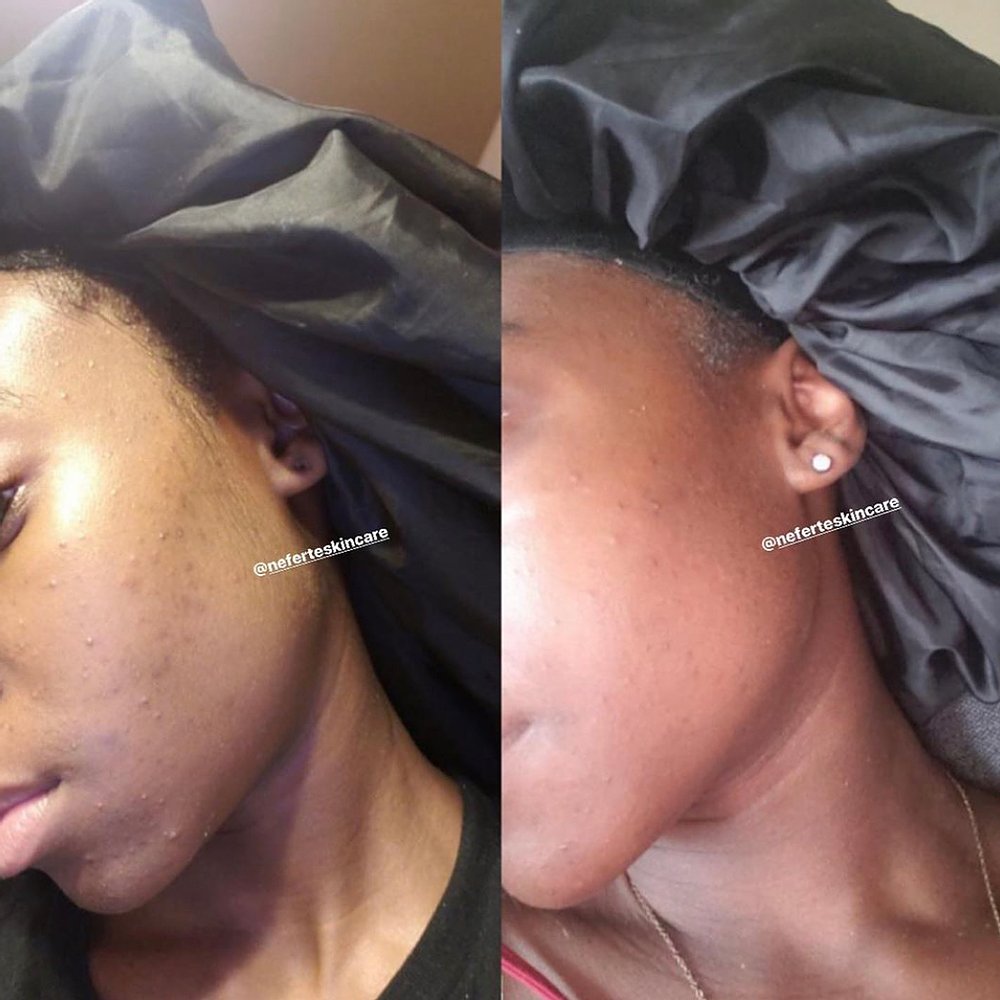 acne spot treatment neferte