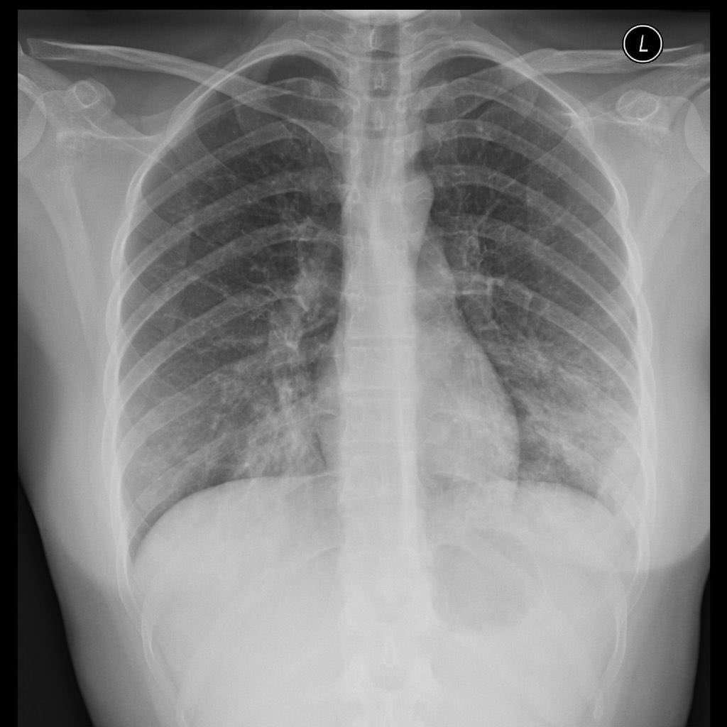 It was an icy and chilly one in Philadelphia today, time for a  #MicroMonday. A 21 year old college student living in a dorm presents with 1 week of general malaise, cough, pleuritic chest pain, and fevers. He has +sick contact. CXR shows the following: