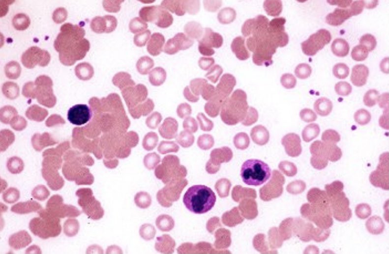 You check hemolysis labs, which show a elevated tbili (indirect predominance), elevated LDH, and low haptoglobin. You diagnose hemolysis as the cause of his anemia. You then check a smear, which shows the following: