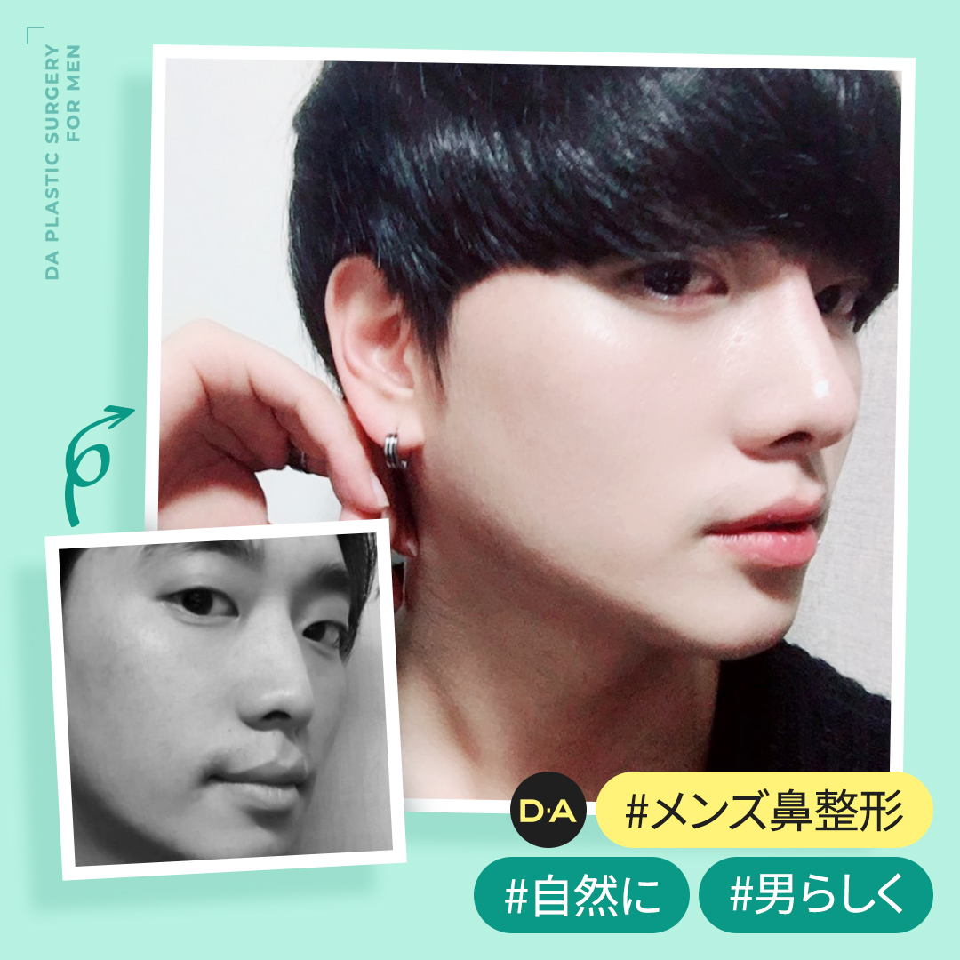 韓国da美容外科 皮膚科 眉の骨からすっきり Da メンズ鼻整形 男性 鼻整形 のポイント お問い合わせは Line T Co Mms2uzdbvd 無料オンラインカウンセリング実施中 韓国整形 韓国整形外科 韓国旅行 カンナム 鼻中隔延長 鼻尖