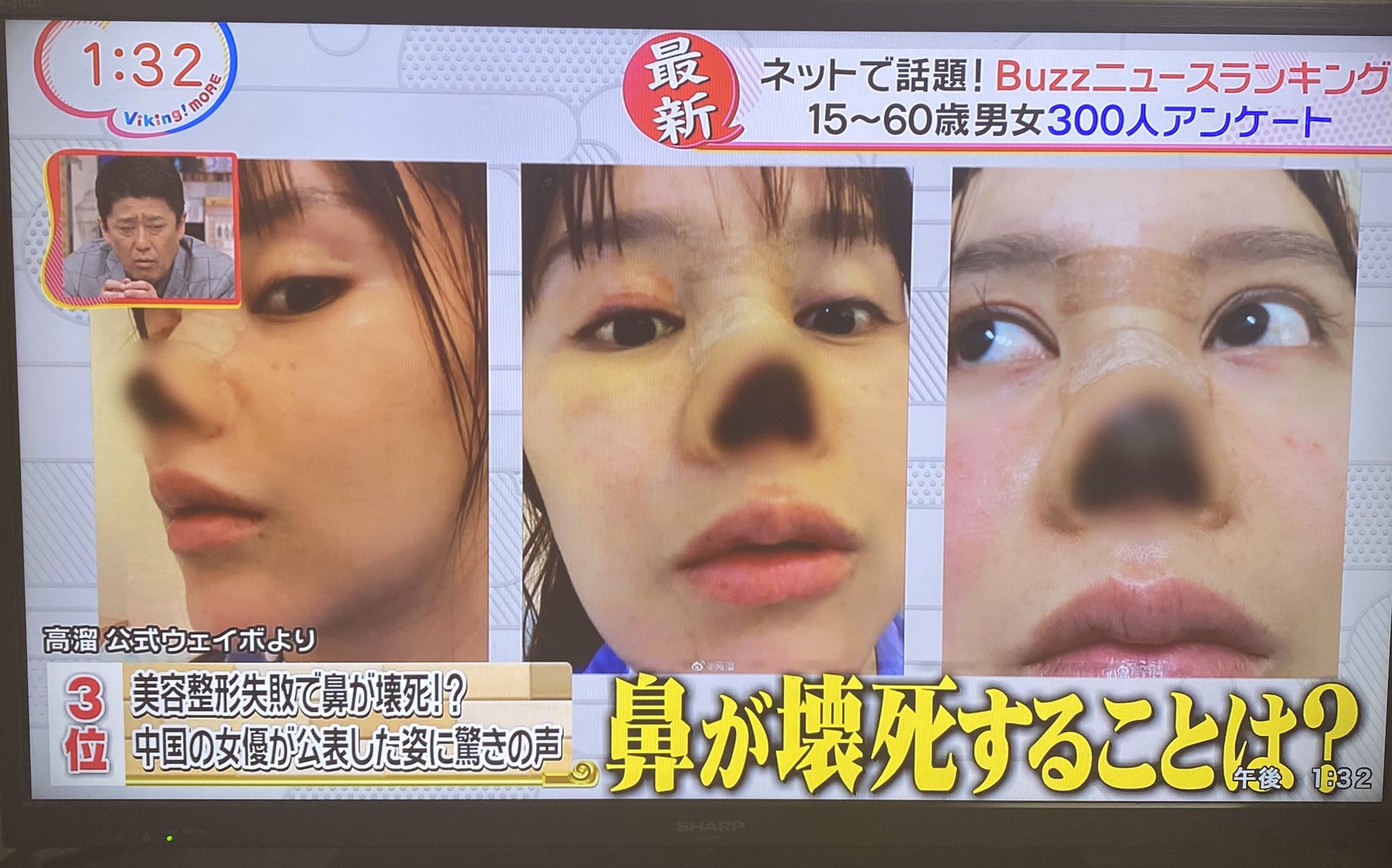 Tkc 事務局 東京美容外科 麻生院長が見解を求められた中国若手女優の鼻の壊死 東京美容外科のドクターは何度も韓国のクリニックに研修に行き高度な技術を取得しています 存在感のない鼻 他院さまの修正など傷跡や合併症のセカンドオピニオンも Tkc 事務局 東京美容外科 麻生院長が見解を求められた中国若手女優の鼻の壊死 東京美容外科のドクターは何度も韓国のクリニックに研修に行き高度な技術を取得しています 存在感のない鼻 他院さまの修正など傷跡や合併症のセカンドオピニオンも