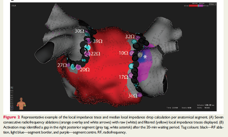 DhirajGuptaBHRS's tweet photo. Value of #localimpedance in #afib #ablation: results of the LOCALIZE trial by our own alumnus Moloy Das, @C_Meyer_MD & colleagues
https://t.co/24FfIiXpfN
@ESC_Journals @BSC_EU_Heart https://t.co/4fMg6sOQwt
