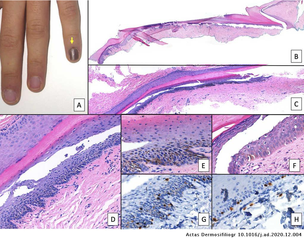 Es posible realizar biopsias adecuadas de las lesiones melanocíticas ungueales sin apenas inducir alteraciones permanentes. Este interesante artículo de <a href="/ActasDS/">Actas DS</a> ofrece una revisión detallada de las distintas técnicas de biopsia actasdermo.org/es-lesiones-me…
